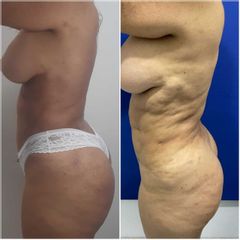 Liposucción - CE Internacional