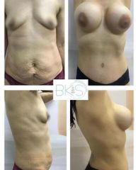 Antes y después de Lipoescultura - CE Internacional