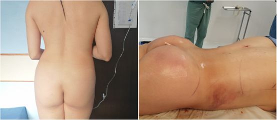 Antes y después de Liposucción - CE Internacional