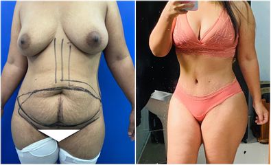 Antes y después de Abdominoplastia - CE Internacional