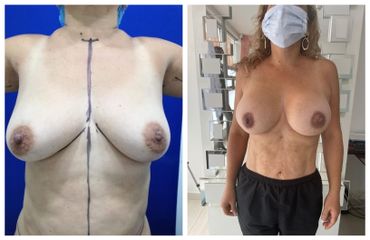 Antes y después de Mastopexia - CE Internacional