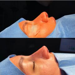 Rinoplastia - Dra. Hossana Martínez Herrera