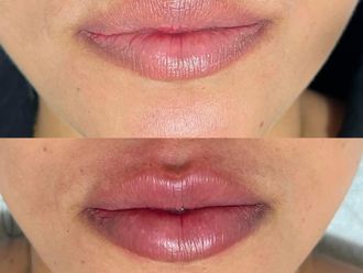 Aumento de labios antes y después - 875682