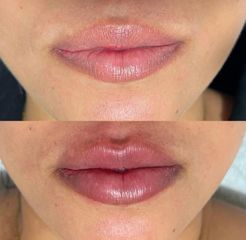 Relleno de labios - Dra. Hossana Martínez Herrera
