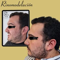 Rinomodelación con hilos - Dr. Gerardo Rascón