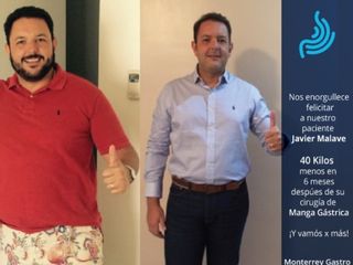 Antes y después de Manga gástrica