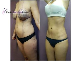 Antes y después de Lipoescultura