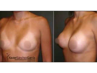 Antes y después de Aumento de busto