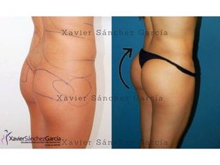 Antes y después de Gluteoplastia