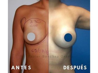 Antes y después de Aumento de busto