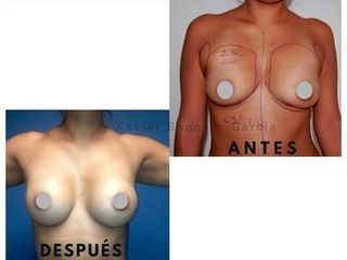 Antes y después de Aumento de busto