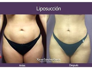 Antes y después de Liposucción