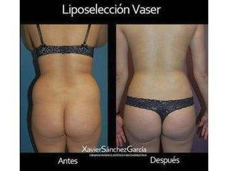 Antes y después de liposelección vaser lipoescultura