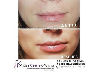 Aumento de labios - 642857