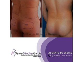 Antes y después de Gluteoplastia