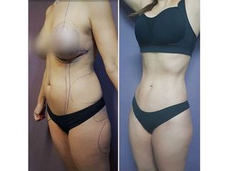 Antes y después de Lipoescultura