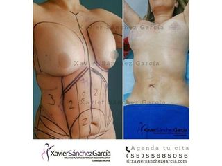 Antes y después de Lipoescultura