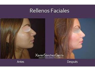 Antes y después de relleno facial con ácido hialurónico