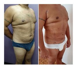 Antes y después de Liposucción Vaser