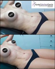 Antes y después de  Liposucción + Aumento de busto