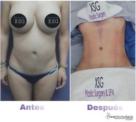 Antes y después de Lipo Vaser