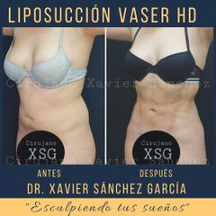 Antes y después de Liposucción Vaser 