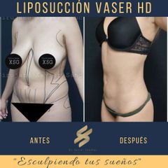 Antes y después de Liposucción