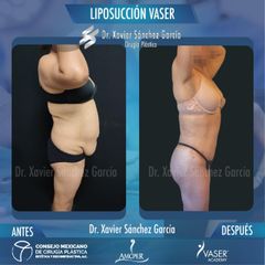 Liposucción - Dr. Xavier Sánchez García