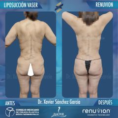 Liposucción - Dr. Xavier Sánchez García