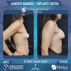 Aumento de mamas