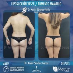 Liposucción VASER - Dr. Xavier Sánchez García