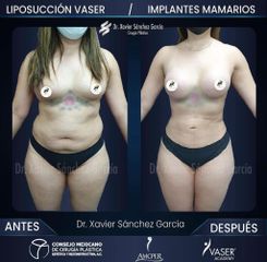 Liposucción VASER - Dr. Xavier Sánchez García