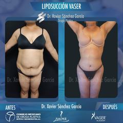 Liposucción - Dr. Xavier Sánchez García