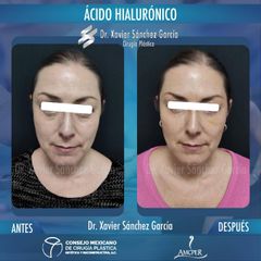 Ácido hialurónico - Dr. Xavier Sánchez García