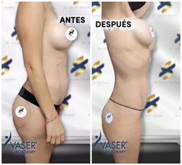 Liposucción - Dr. Xavier Sánchez García