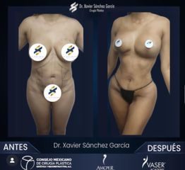 Lipo VASER - Dr. Xavier Sánchez García