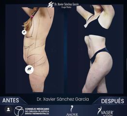 Liposucción  VASER - Dr. Xavier Sánchez García