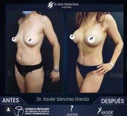 Liposucción VASER - Dr. Xavier Sánchez García