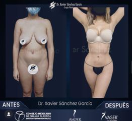 Lipo VASER - Dr. Xavier Sánchez García