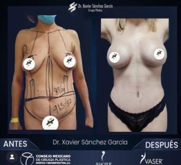 Lipo VASER pexia mamaria - Dr. Xavier Sánchez García