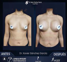 Aumento de busto - Dr. Xavier Sánchez García
