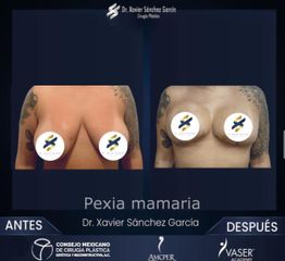 Reducción mamas - Dr. Xavier Sánchez García