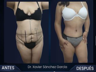Abdominoplastia - 853369
