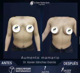 Aumento mamario - Dr. Xavier Sánchez García