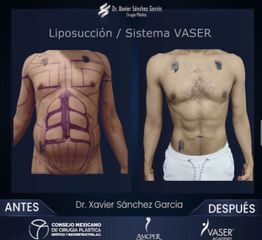 Liposucción VASER - Dr. Xavier Sánchez García