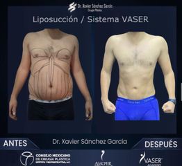 Liposucción  VASER - Dr. Xavier Sánchez García
