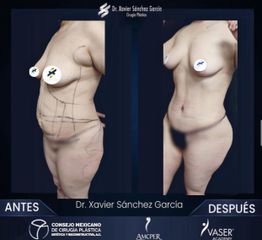 Abdominoplastia 360 - Dr. Xavier Sánchez García