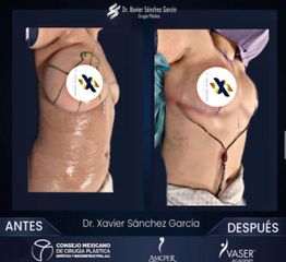 Reducción mamas - Dr. Xavier Sánchez García