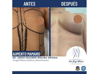 Aumento de busto - Dr. Jorge Molina