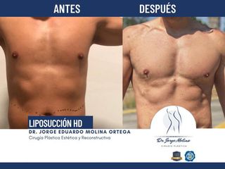 Liposucción HD - Dr. Jorge Molina